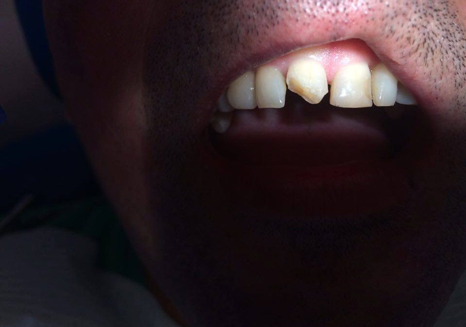 Urazy zębów – jak postępować?