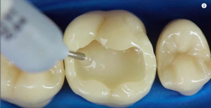 SDR, czyli wypełnienia w zębach bocznych